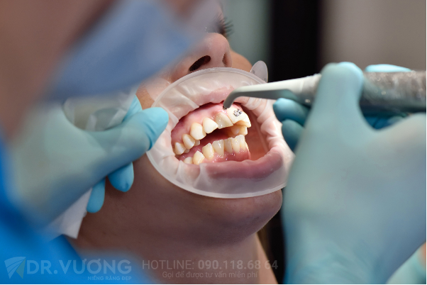 Thực hư việc nhổ răng khi niềng ảnh hưởng đến dây thần kinh - Ảnh 4.