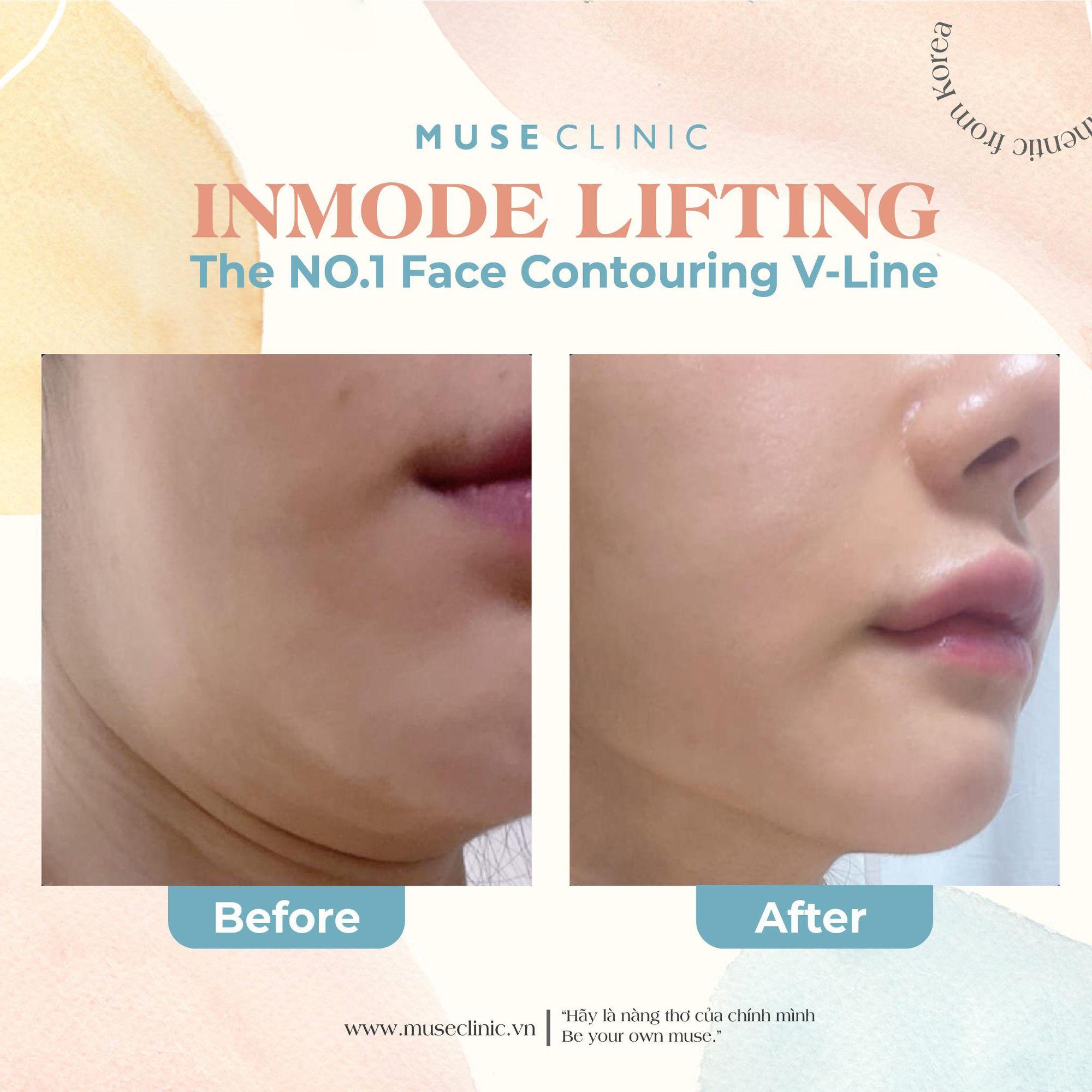 Top 3 Korean V-Line shaping procedures with Muse Clinic - Photo 3.