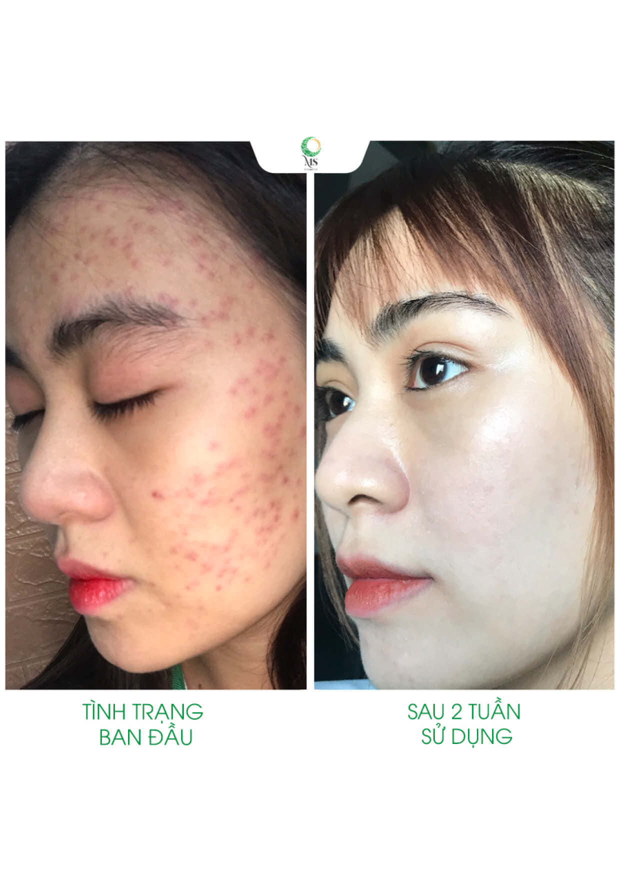 Thanh lăn mụn Ms Cosmetic giúp giảm các dấu hiệu mụn, thâm cứng đầu - Ảnh 3.