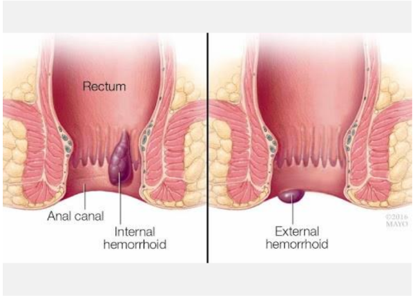 Bạn đã biết cách cải thiện bệnh trĩ theo cách hoàn toàn mới chưa? - Ảnh 1.