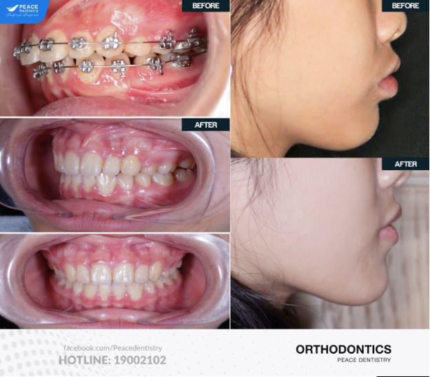 Tìm hiểu các dịch vụ của hệ thống nha khoa Peace Dentistry - Ảnh 4.