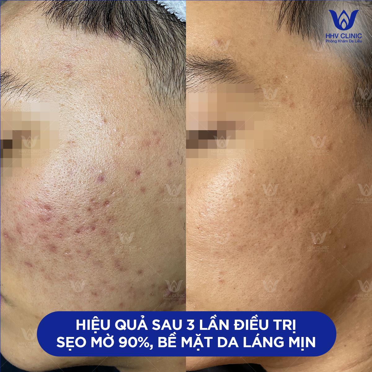 Phòng khám da liễu HHV Clinic - Địa chỉ điều trị mụn tại TP. HCM - Ảnh 2.