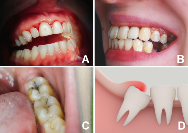 5 phút kiểm tra tình trạng răng của bạn - Ảnh 2.