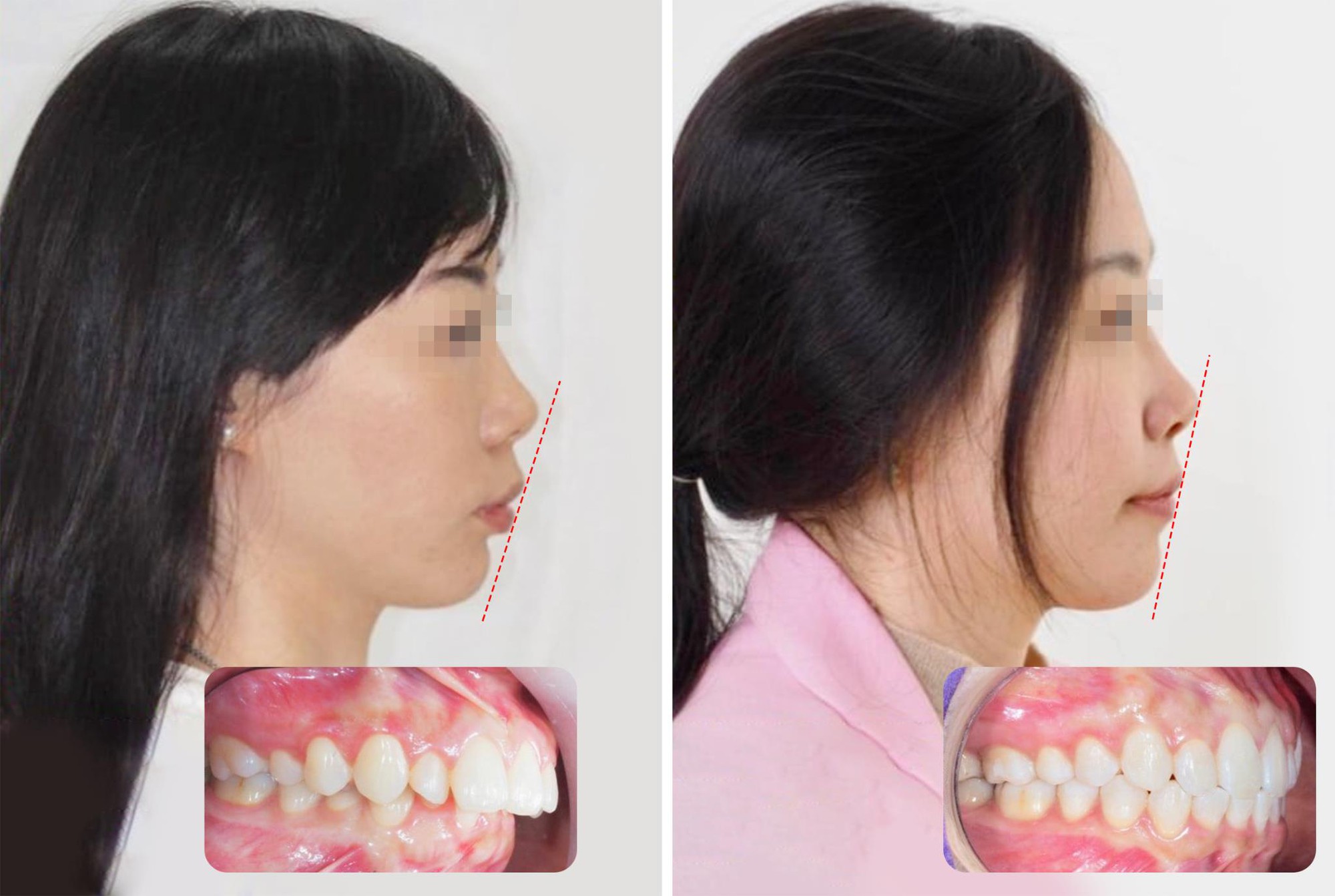 Niềng răng tuổi 35: Hiểu đúng sẽ không còn là nỗi lo - Ảnh 1.