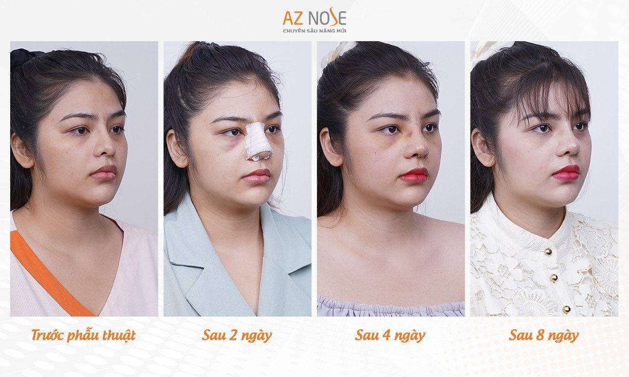 Ứng dụng Surgiform trong tái tạo mũi hỏng tại AZ Nose - Ảnh 1.