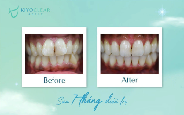 Thương hiệu niềng răng trong suốt Arrasmile đổi tên thành Kiyoclear Việt Nam - Ảnh 3.