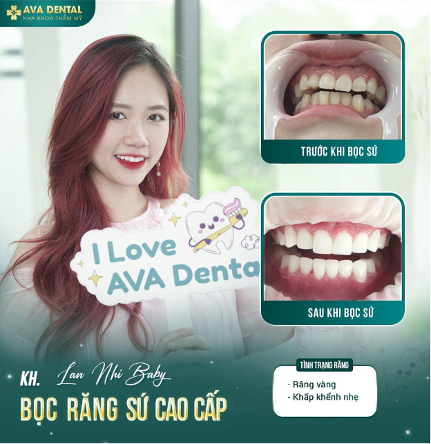 AVA Dental - Địa chỉ uy tín của Việt kiều làm răng sứ Orodent Bleach Innovation - Ảnh 4.