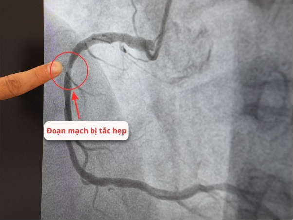 Vượt hơn 100km tới BV Hồng Ngọc vì muốn người đặt stent là Bs Hải - Ảnh 1.