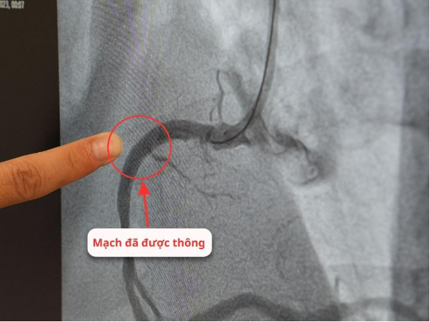 Vượt hơn 100km tới BV Hồng Ngọc vì muốn người đặt stent là Bs Hải - Ảnh 2.