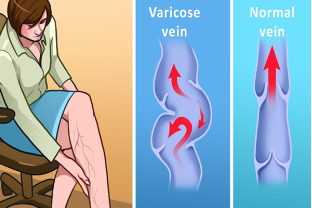 TPBVSK Dulcit – chất lượng sản phẩm thảo dược đến từ Pháp bảo vệ tĩnh mạch chân - Ảnh 1.