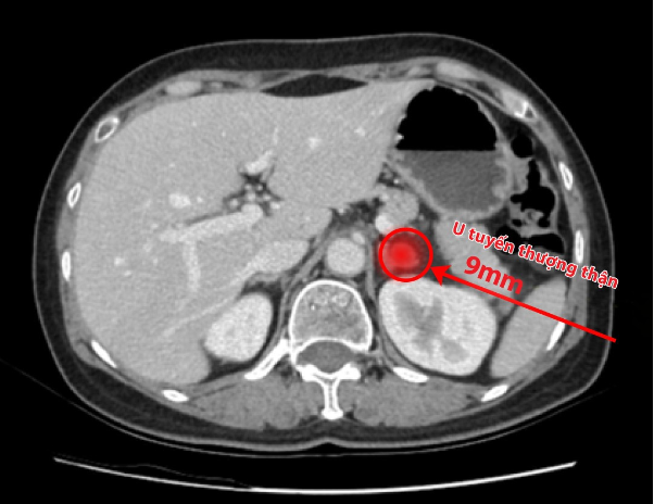 Hiếm gặp: U tuyến thượng thận siêu nhỏ, hành hạ bệnh nhân 6 năm - Ảnh 1. Hiếm gặp: U tuyến thượng thận siêu nhỏ, hành hạ bệnh nhân 6 năm - Ảnh 1.