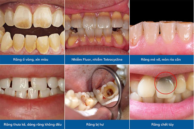 Nên hay không làm răng bọc sứ nguyên hàm? - Ảnh 2.