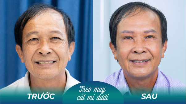 Sụp mí nam tuổi trung niên phải làm sao? - Ảnh 1. Sụp mí nam tuổi trung niên phải làm sao? - Ảnh 1.