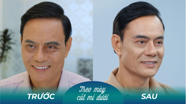 Sụp mí nam tuổi trung niên phải làm sao? - Ảnh 2. Sụp mí nam tuổi trung niên phải làm sao? - Ảnh 2.