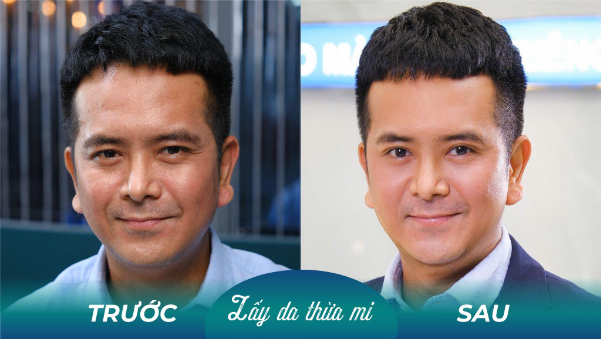 Sụp mí nam tuổi trung niên phải làm sao? - Ảnh 3. Sụp mí nam tuổi trung niên phải làm sao? - Ảnh 3.