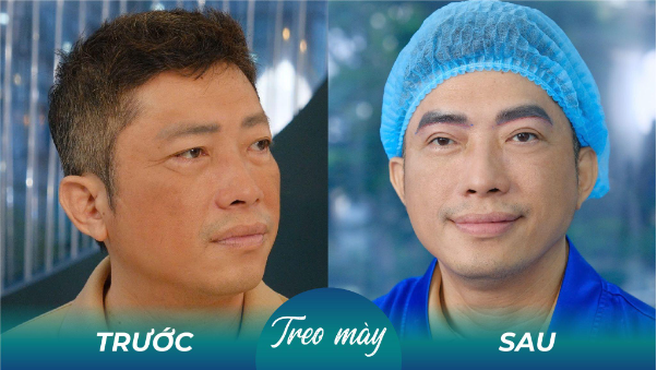 Sụp mí nam tuổi trung niên phải làm sao? - Ảnh 4. Sụp mí nam tuổi trung niên phải làm sao? - Ảnh 4.