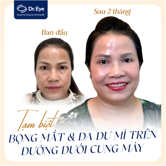 Tham khảo ý kiến bác sĩ về xử trí bọng mắt to - Ảnh 1.