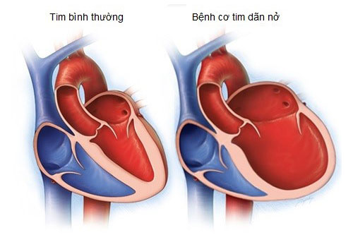 Bệnh cơ tim dãn nở: Vai trò quan trọng của dinh dưỡng và Selen trong phòng ngừa và điều trị  - Ảnh 2.