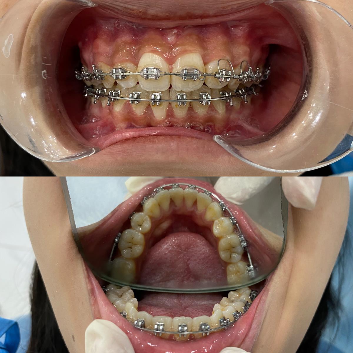 Nha khoa ST Dentist - Nơi niềng răng giá tốt cho Gen Z - Ảnh 6.