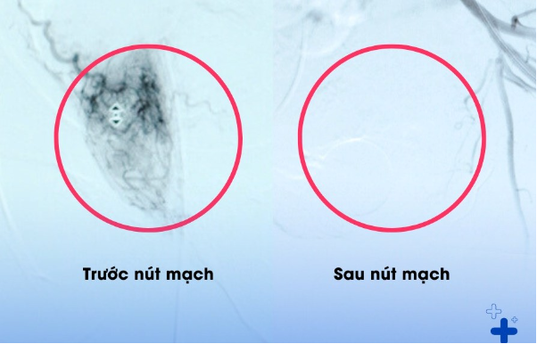 5 tháng bí tiểu, tiểu máu, bệnh nhân bay từ Úc về Việt Nam để nút mạch tuyến tiền liệt - Ảnh 1.