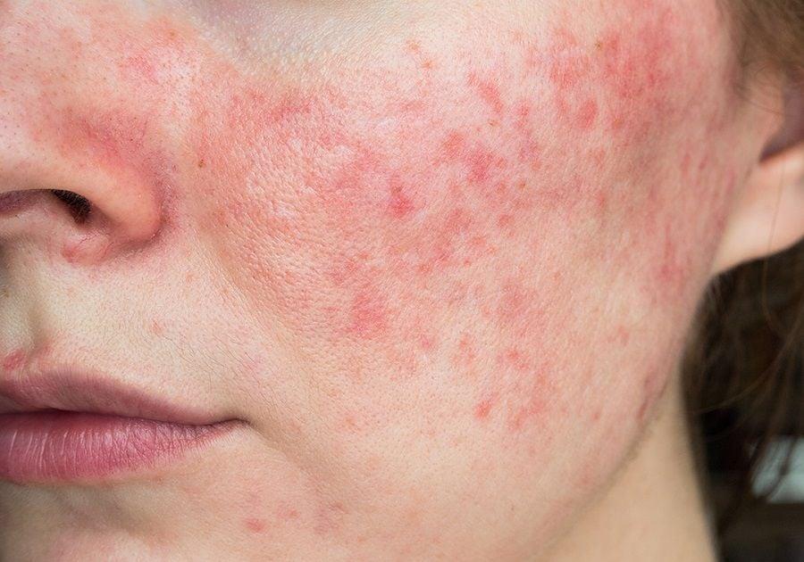 Chăm Da Nhiễm Corticoid Cùng Chuyên Gia Da Liễu Thành Nguyễn Skin - Ảnh 1.