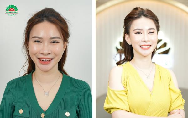 Răng hàm mặt Bệnh viện Hồng Ngọc - Địa chỉ làm đẹp răng đón Tết được ưa chuộng- Ảnh 4.