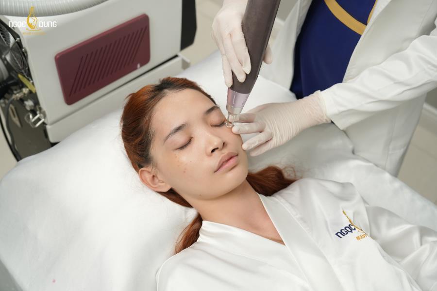 Laser se khít lỗ chân lông: Giải pháp cho làn da mịn màng tức thì- Ảnh 4.