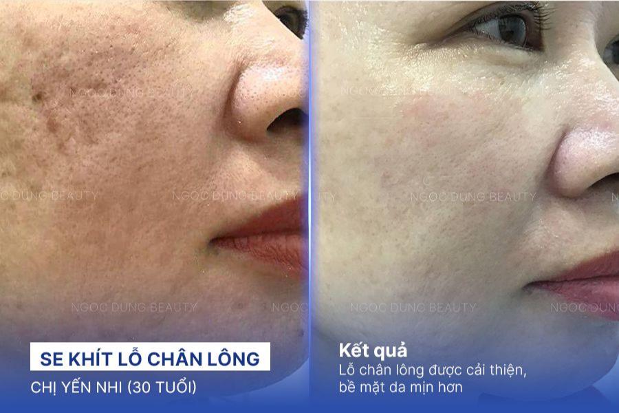 Laser se khít lỗ chân lông: Giải pháp cho làn da mịn màng tức thì- Ảnh 5.