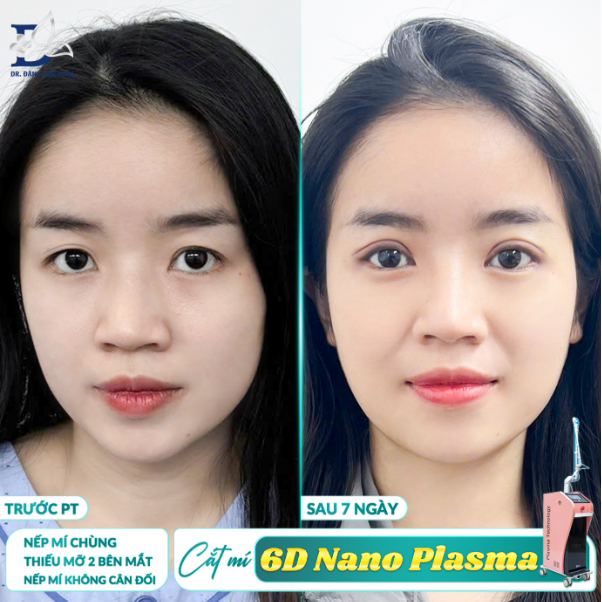 Dr. Định – Bàn tay vàng trong thẩm mỹ mắt, chuyên gia cắt mí 6D Nano Plasma Pro - Ảnh 3.