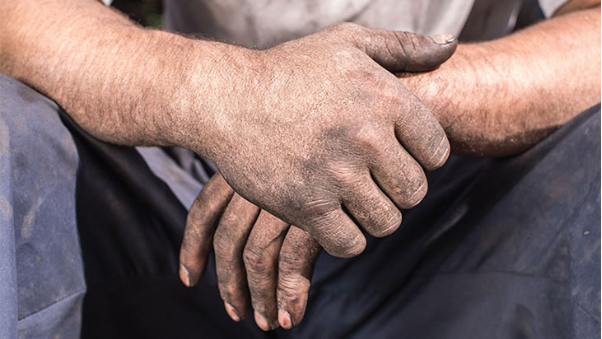 Giảm "phí tổn da liễu" cho mọi người: Giải pháp không corticoid giá hợp lý- Ảnh 1.