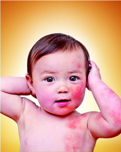 Những điều mẹ cần biết khi con dị ứng đạm sữa b&ograve; 1