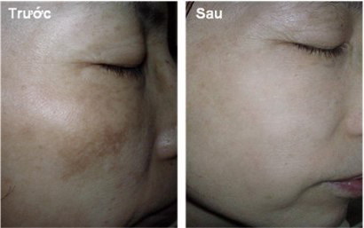 L&agrave;m sao để da hết th&acirc;m - n&aacute;m - t&agrave;n nhang? 5