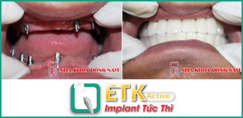 Tìm hiểu quy trình cấy ghép Implant ETK Active - Ảnh 4.