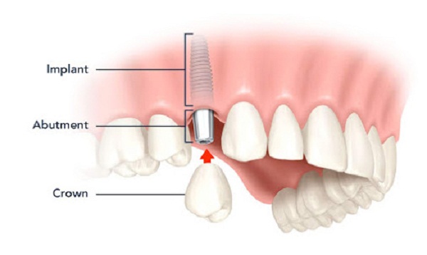 Xu hướng cấy ghép răng giả và những điều bạn cần biết - Ảnh 1.