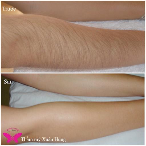Tự tin ch&agrave;o h&egrave;, với c&ocirc;ng nghệ triệt l&ocirc;ng bằng năng lượng &aacute;nh s&aacute;ng IPL - Ảnh 3.