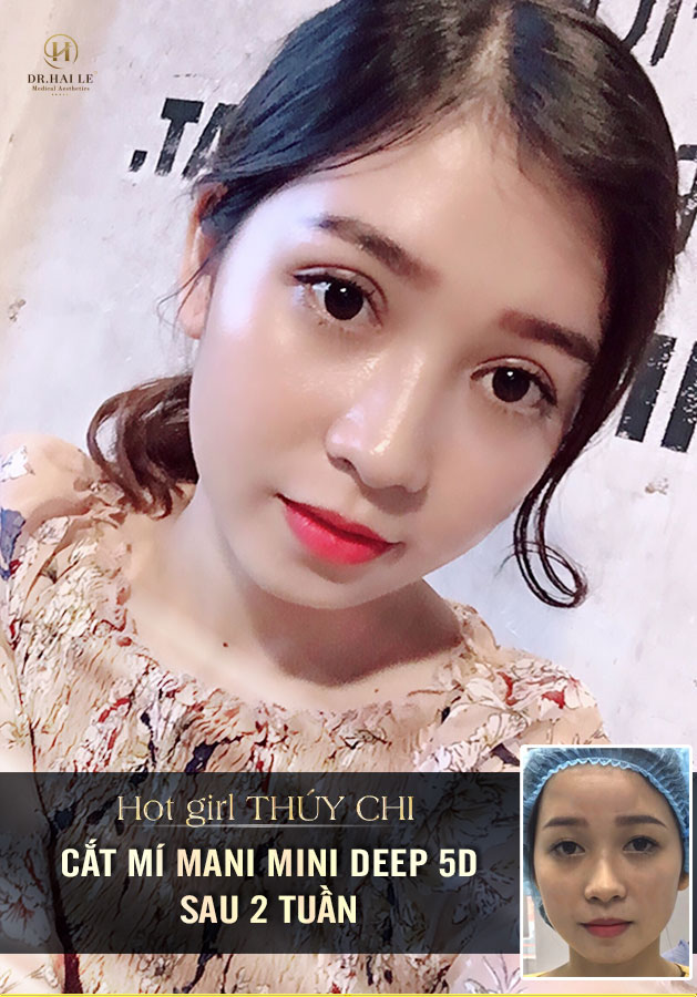 Hotgirl cover Sài thành Thúy Chi “lột xác” sau cắt mí Mani Mini Deep 5D - Ảnh 1.