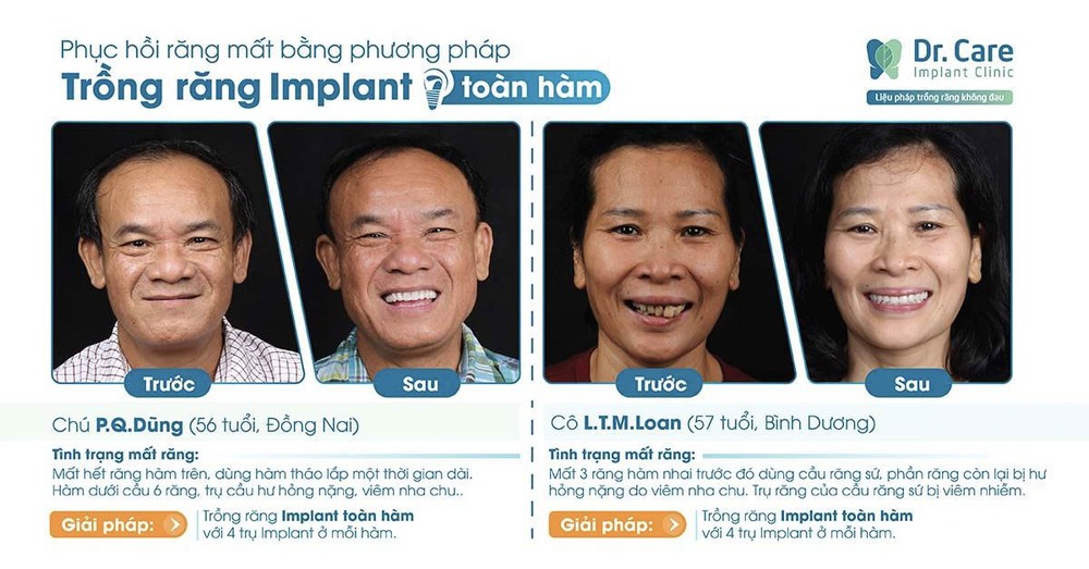 Giá trồng răng Implant bao nhiêu? Có nên trồng lại răng với Implant? - Ảnh 2.