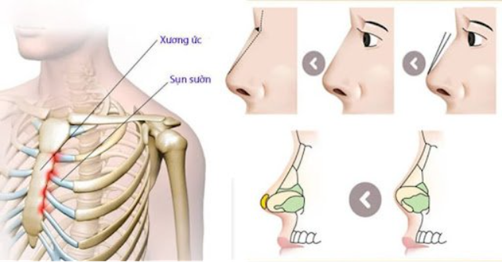 Những lưu ý khi nâng mũi sụn tự thân mà không phải ai cũng biết - Ảnh 1.