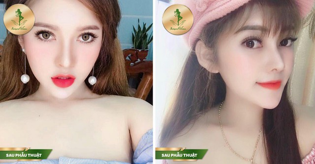 N&acirc;ng mũi Sform, Sform Plus đột ph&aacute; mới cho d&aacute;ng mũi ho&agrave;n hảo - Ảnh 5.