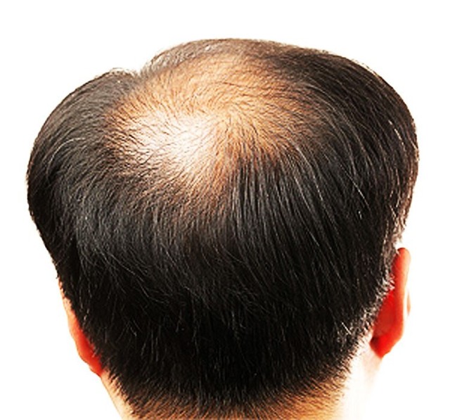 Tin vui cho các chàng bị hói đầu, mẹo này giúp tóc mọc nhanh lại chẳng lo tác dụng phụ - Ảnh 2.