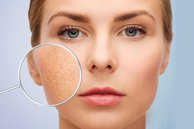 B&iacute; quyết ti&ecirc;u diệt sẹo rỗ cực đơn giản của con g&aacute;i xứ H&agrave;n, th&agrave;nh c&ocirc;ng đến 99% - Ảnh 2.