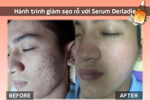 B&iacute; quyết ti&ecirc;u diệt sẹo rỗ cực đơn giản của con g&aacute;i xứ H&agrave;n, th&agrave;nh c&ocirc;ng đến 99% - Ảnh 7.