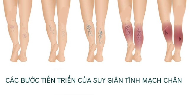 Thực phẩm bảo vệ sức khỏe TRISELAN+ giải pháp hỗ trợ điều trị triệu chứng Trĩ, Táo Bón và Suy Giãn Tĩnh Mạch - Ảnh 2.