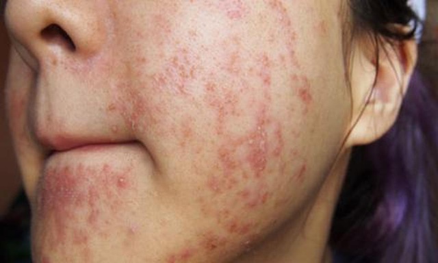 Mua kem sẹo Rejuvaskin - Scar Heal ch&iacute;nh h&atilde;ng ở đ&acirc;u? - Ảnh 2.