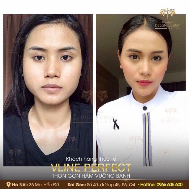 Beauty Center: Địa chỉ thực hiện Vline Perfect - Thon gọn mặt không phẫu thuật hàng đầu Việt Nam - Ảnh 1.