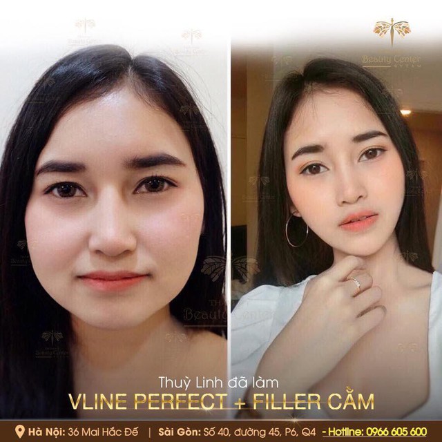 Beauty Center: Địa chỉ thực hiện Vline Perfect - Thon gọn mặt không phẫu thuật hàng đầu Việt Nam - Ảnh 2.