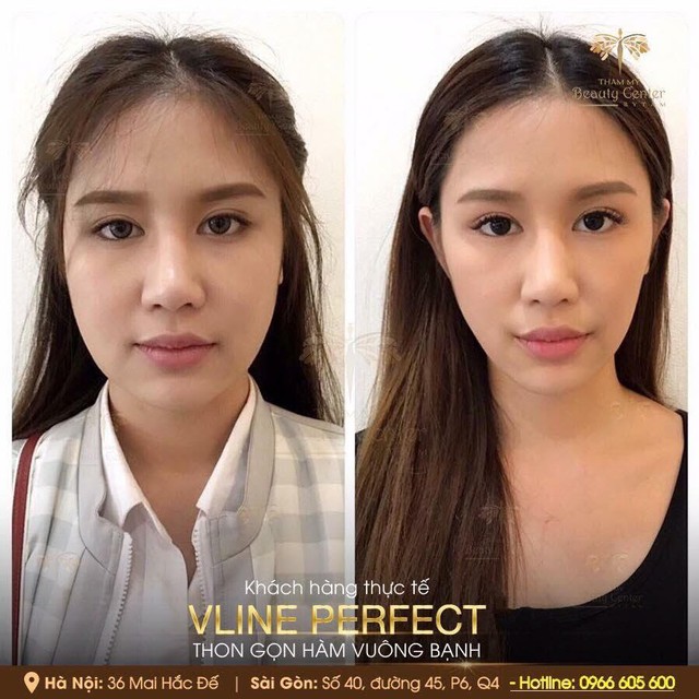 Beauty Center: Địa chỉ thực hiện Vline Perfect - Thon gọn mặt không phẫu thuật hàng đầu Việt Nam - Ảnh 3.