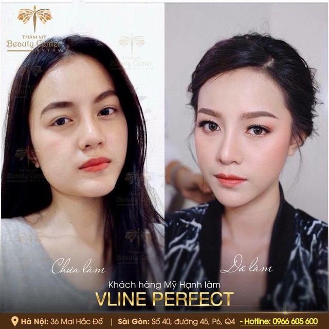 Beauty Center: Địa chỉ thực hiện Vline Perfect - Thon gọn mặt không phẫu thuật hàng đầu Việt Nam - Ảnh 4.