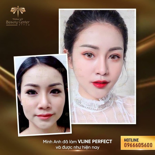 Beauty Center: Địa chỉ thực hiện Vline Perfect - Thon gọn mặt không phẫu thuật hàng đầu Việt Nam - Ảnh 5.