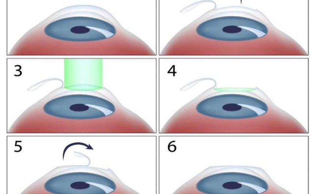 So sánh 3 phương pháp phẫu thuật khúc xạ phổ biến hiện nay: Lasik – Femto Lasik và Relex Smile - Ảnh 2.